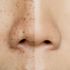 Ciltte pigment bozukluğu nedir? Pigment bozukluğunun nedenleri, çeşitleri ve tedavisi… Ciltte pigment bozukluğu nedir? Pigment bozukluğunun nedenleri, çeşitleri ve tedavisi…