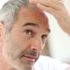 Saçkıran (Alopesi areata) nedir? Saçkıran hastalığının nedenleri, belirtileri ve tedavisi… Saçkıran (Alopesi areata) nedir? Saçkıran hastalığının nedenleri, belirtileri ve tedavisi…
