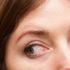 Gözlerdeki kanlanma göz tümörünün belirtisi olabilir!