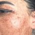 Aslı İlhan, kabus gibi günler yaşadı: Cilt toparlama seansı ile yüzünde yanıklar oluştu Aslı İlhan, kabus gibi günler yaşadı: Cilt toparlama seansı ile yüzünde yanıklar oluştu