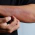 Ciltte mantar enfeksiyonu nedir? Ciltte mantar enfeksiyonları neden olur? Mantar enfeksiyonu belirtileri ve tedavisi… Ciltte mantar enfeksiyonu nedir? Ciltte mantar enfeksiyonları neden olur? Mantar enfeksiyonu belirtileri ve tedavisi…