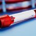 Anti-Müllerian Hormon Testi (AMH) nedir? AMH ne kadar olmalıdır? Anti-Müllerian Hormon Testi (AMH) nedir? AMH ne kadar olmalıdır?