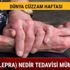 Cüzzam nedir nasıl bulaşır (Lepra) Cüzzam hastalığı belirtileri nedir tedavisi var mı?