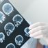 Epilepsi hastalarına sıcak hava uyarısı Epilepsi hastalarına sıcak hava uyarısı