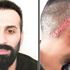Saç ekimine 'taksirle yaralama' soruşturması
