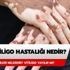 Vitiligo hastalığı nedir? Vitiligo hastalığı yayılır mı? Vitiligo hastalığı nedir? Vitiligo hastalığı yayılır mı?