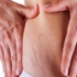 Vücuttaki çatlakların suçlusu hormonlar !