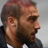 Cenk Tosun'da 5 santim kesik 12 dikiş!