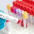 Türkiye’de 4 milyon hepatitli hasta var
