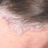 Seboreik dermatit nedir? Seboreik dermatit nedir?